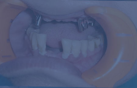 Dental Implant