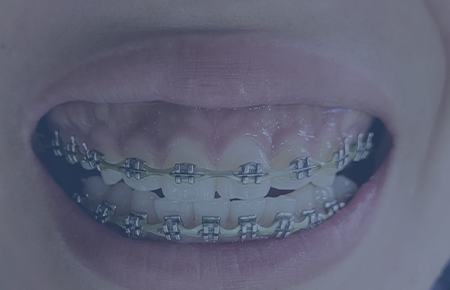 Orthodontic Treatments                            